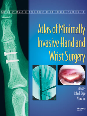 cover image of Atlas of Minimally Invasive Hand and Wrist Surgery